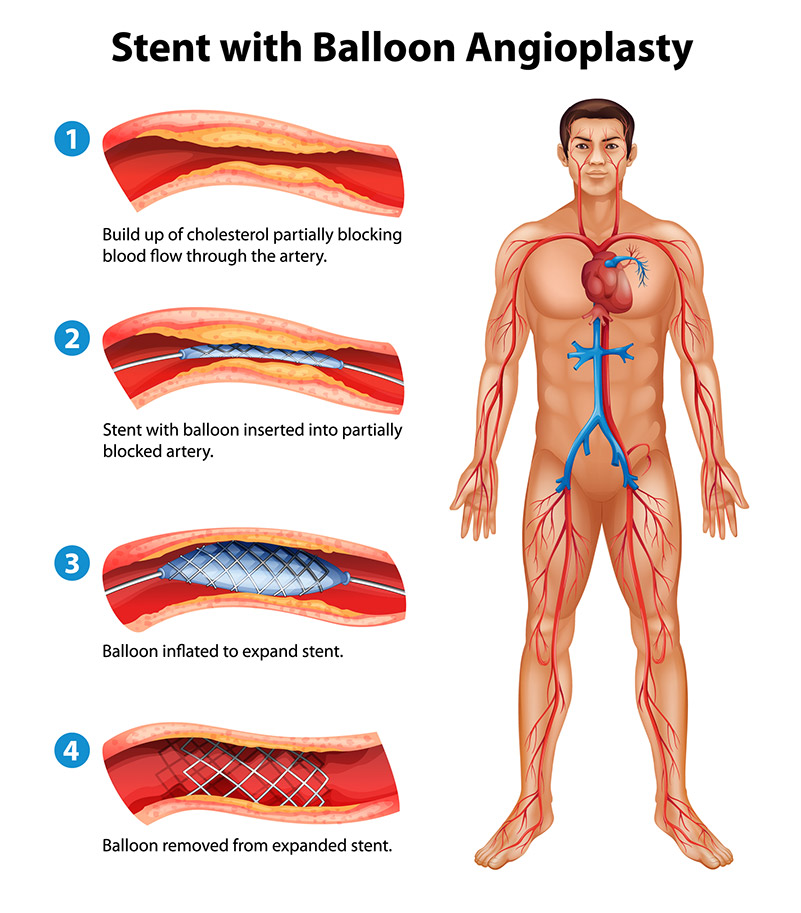 stent illustration